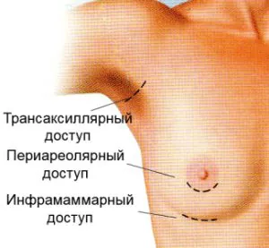 Протезирование груди в Москве 