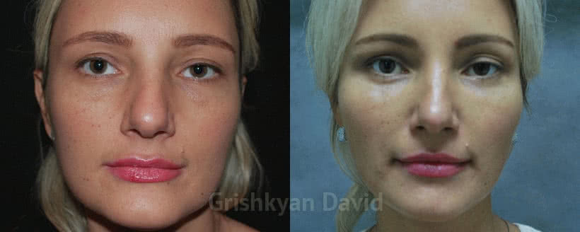 Фото Фото до и после липофилинг лица