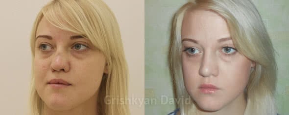 Фото Реконструктивная ринопластика — фото до и после операции