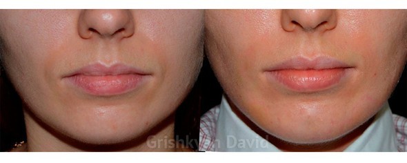 Фото Липофилинг губ  — фото до и после
