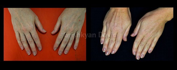 Липофилинг рук — фото до и после