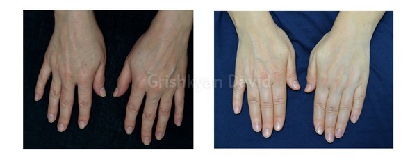 Липофилинг рук — фото до и после