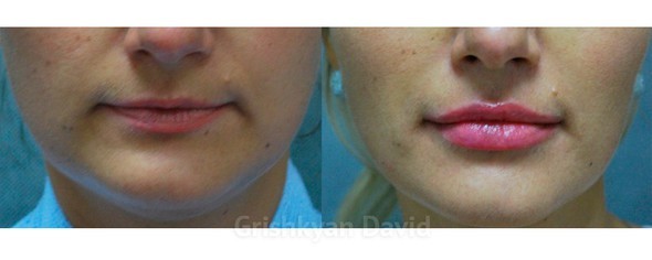 Фото Липофилинг губ  — фото до и после
