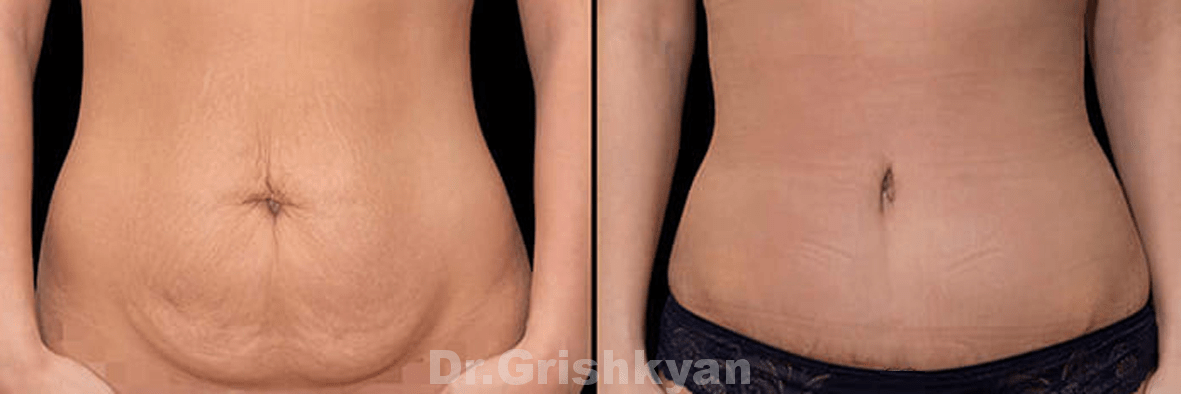 Абдоминопластика (пластика живота): фото до и после
