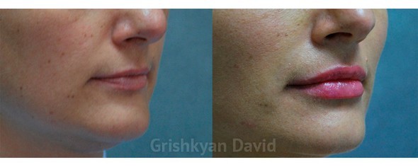 Липофилинг губ  — фото до и после
