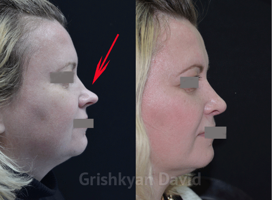 Фото до и после пластики кончика носа