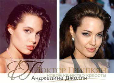 Фото звездной операции Анджелины Джоли до и после операции