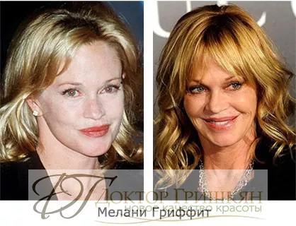 Фото звездной операции Мелани Гриффит до и после операции