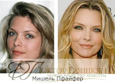 Фото звездной операции Мишель Пфайфер до и после операции