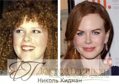 Фото звездной операции Николь Кидман до и после операции