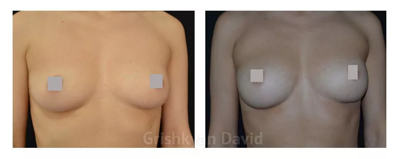 Увеличение груди собственным жиром фото до и после операции