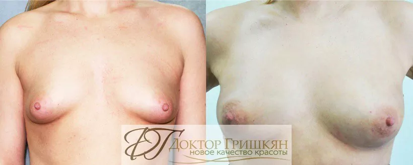 Липофилинг груди фото до и после 2