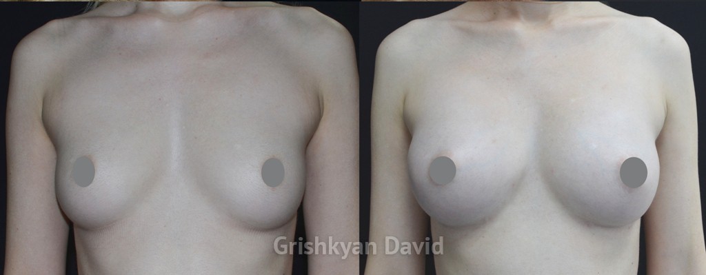 липофилинг груди в Москве фото до и после 