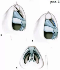 Доктор Гришкян - пластика носа Трансплантация фото 3