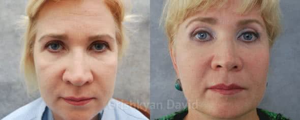 Фото Липофилинг лица — фото до и после