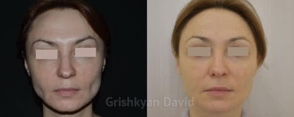 Фото Липофилинг лица — фото до и после