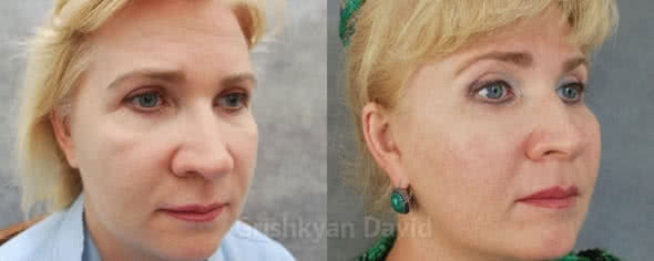 Липофилинг лица — фото до и после