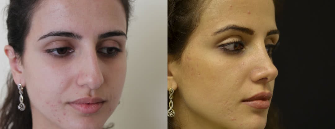 Ринопластика — фото до и после