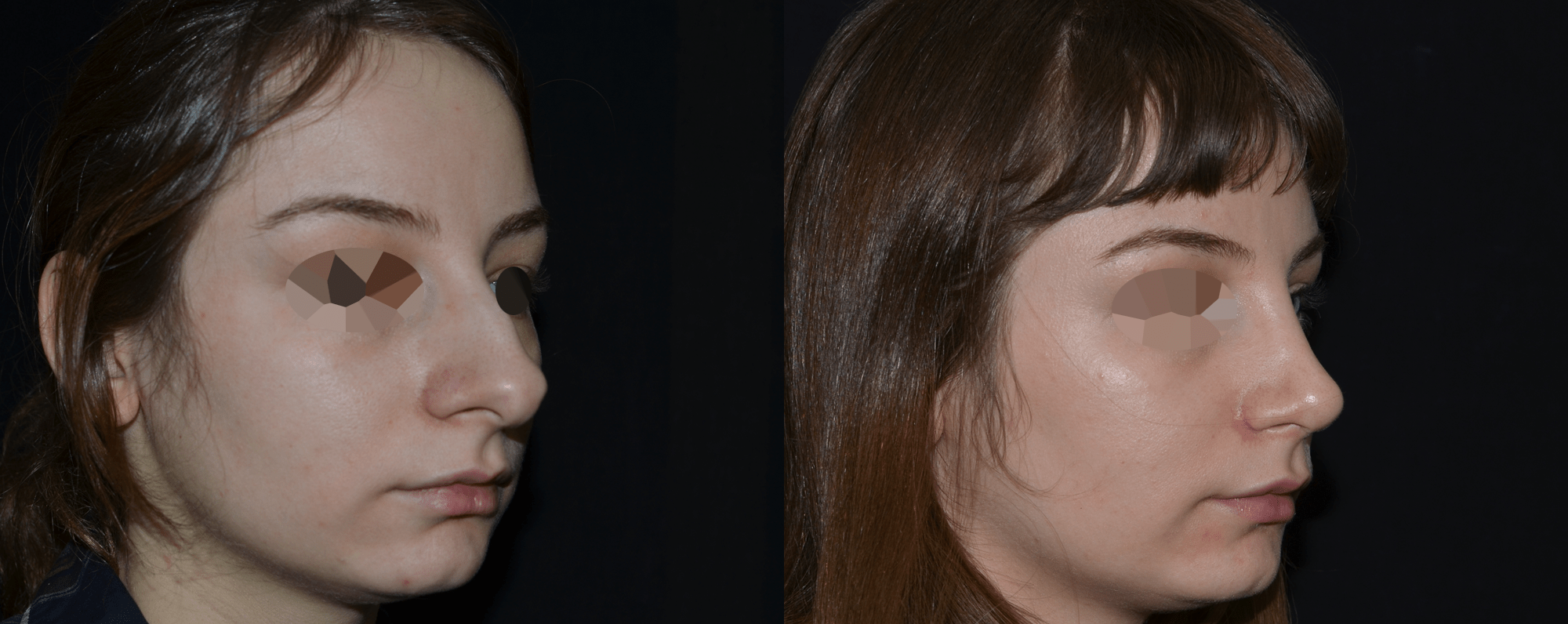 Ринопластика — фото до и после