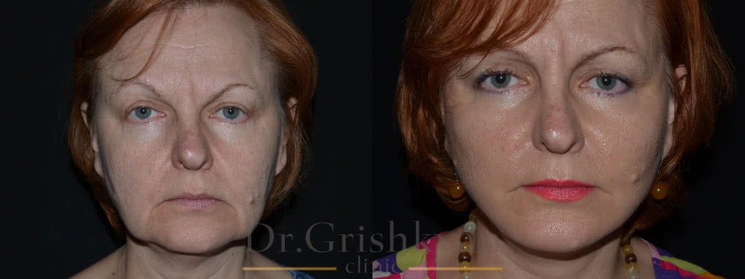 Фото Фото до и после пластики лица