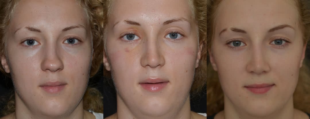 Нос через 8 дней после операции, фото до и после