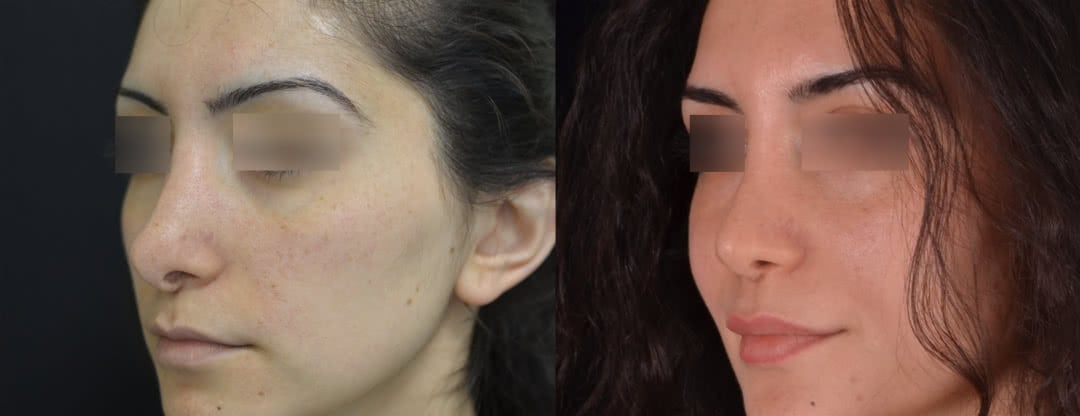 Фото до и после третей ринопластики (реконструкция носа)