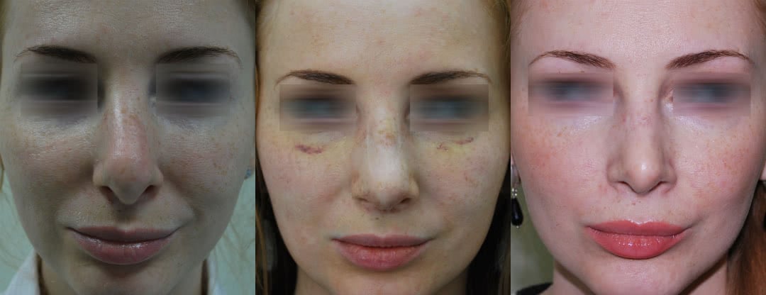 Фото до и после повторной пластики носа (до, после снятия гипса, через 6 месяцев)