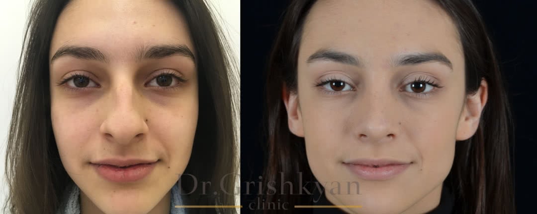 Фото Ринопластика фото до и после, исправления горбинки и кончика носа