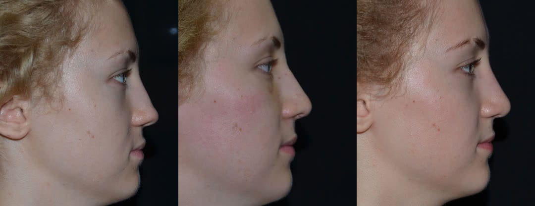 Нос через 8 дней после операции, фото до и после