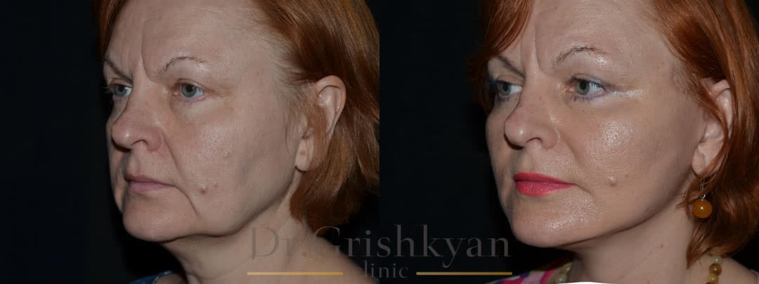 Фото до и после пластики лица