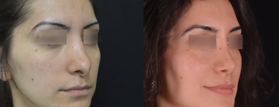 Фото до и после третей ринопластики (реконструкция носа)