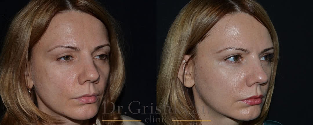 Фото до и после липофилинг лица