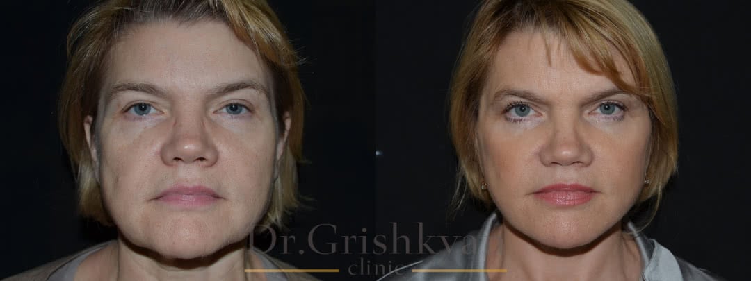 результат до и после пластики лица