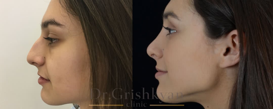 Ринопластика фото до и после, исправления горбинки и кончика носа