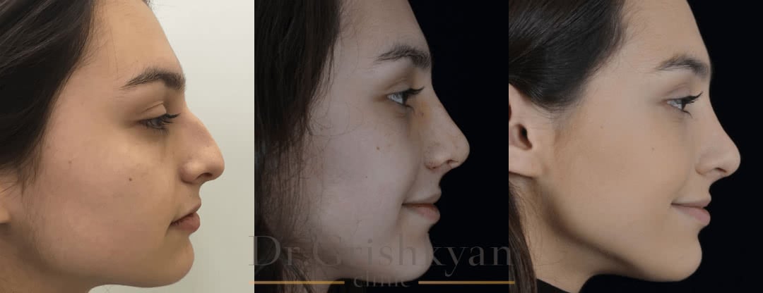 Миф 2. С помощью операции носу можно придать любую форму.