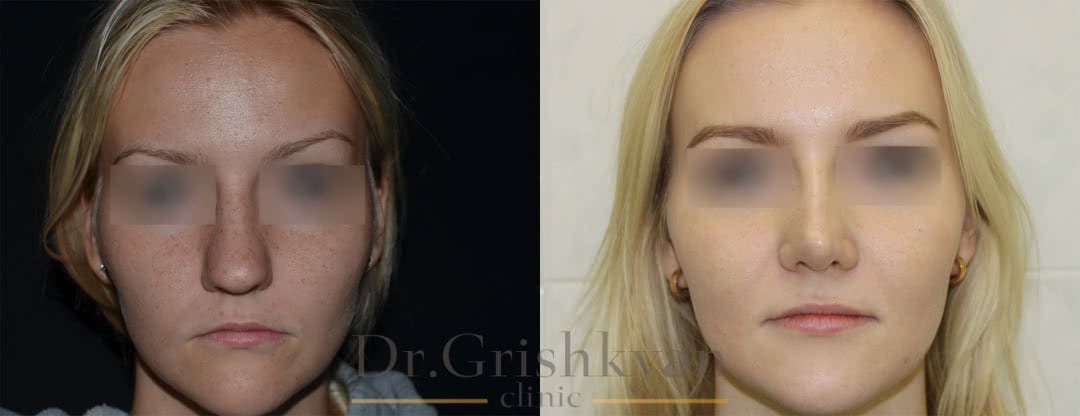 Фото Пропорции лица после ринопластики фото