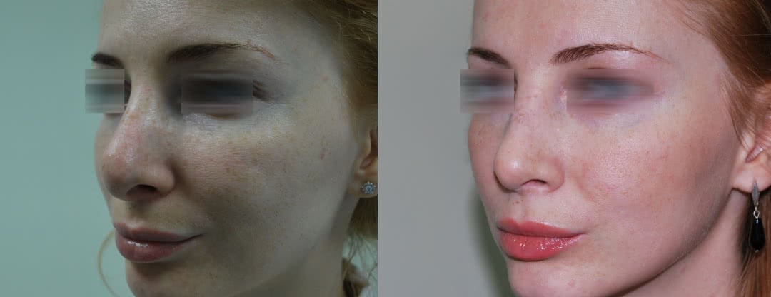 Фото Фото до и после повторной носа (третья операция)