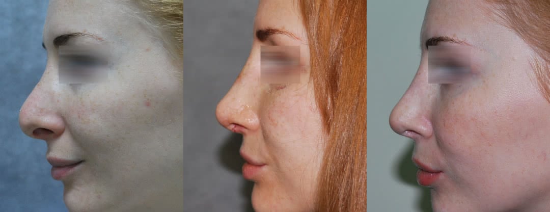 Фото до и после повторной пластики носа (до, после снятия гипса, через 6 месяцев)