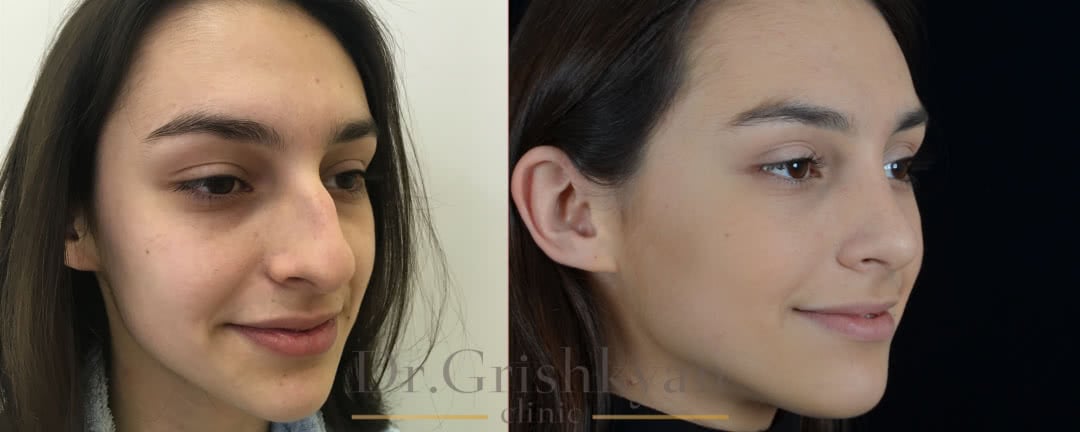 Ринопластика фото до и после, исправления горбинки и кончика носа