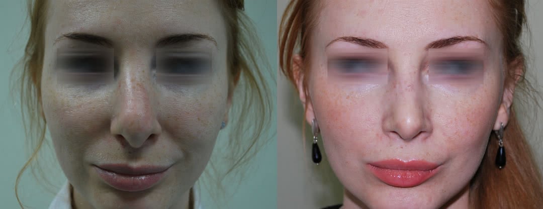 Фото до и после повторной носа (третья операция)