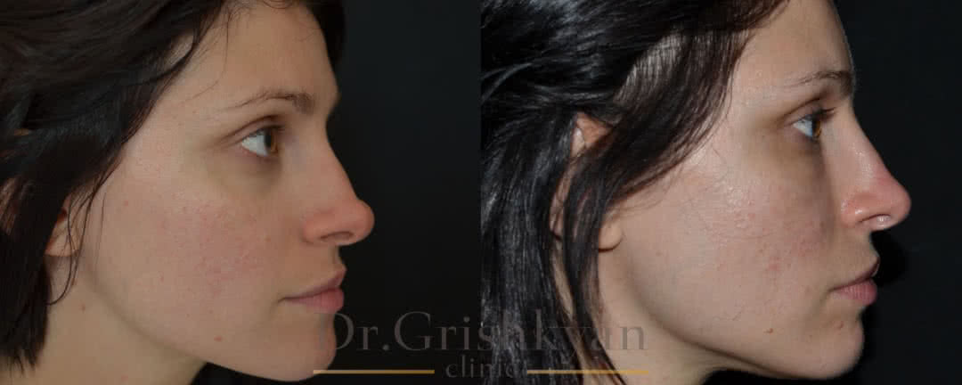 Фото до и после липофилинг лица