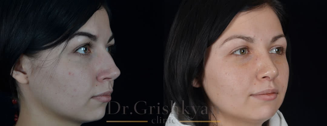 Фото Фото до и после повторной ринопластики в клинике в москве