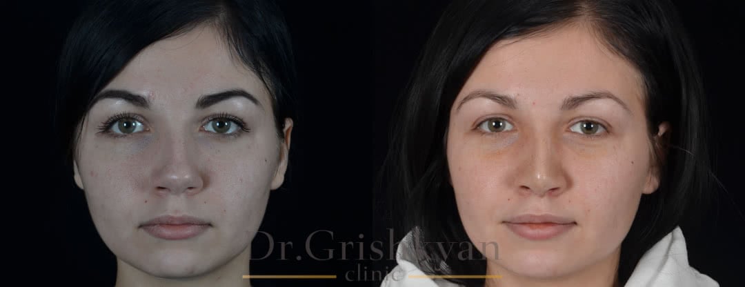 Фото до и после повторной ринопластики в клинике в москве