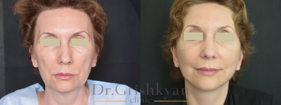 Фото до и после пластики лица