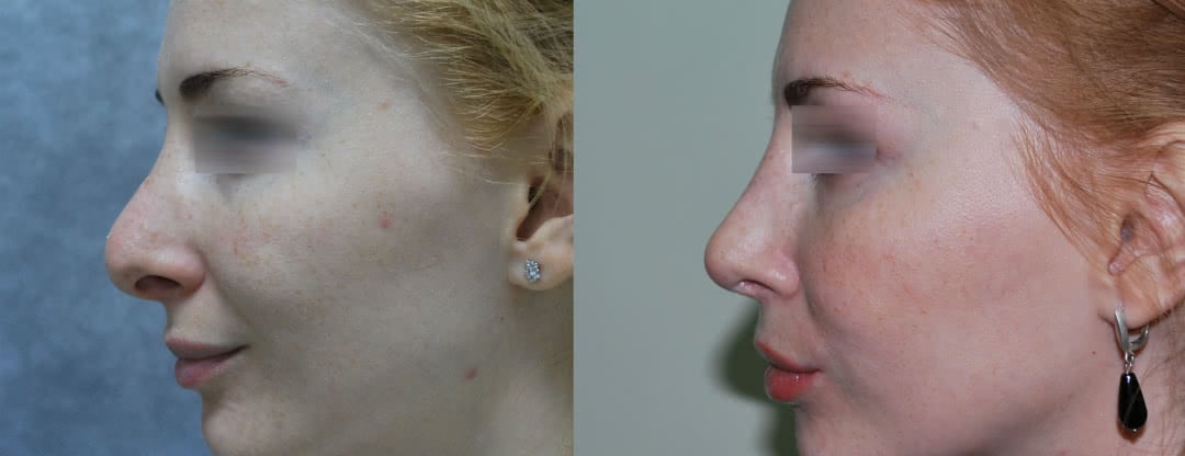 Фото до и после повторной носа (третья операция)