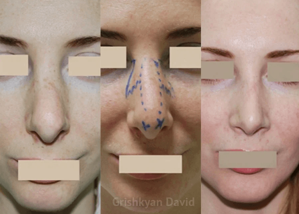 Фото результат до (после другого хирурга) и после повторной пластики носа