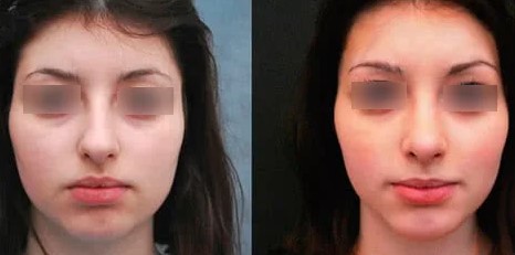 Фото омоложение после липофилинга, фото до и после
