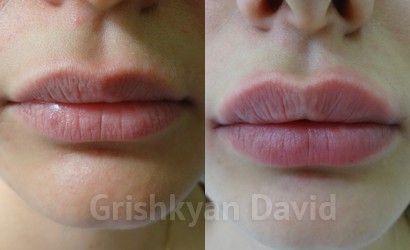 Фото Увеличение губ филлерами в клинике Гришкяна