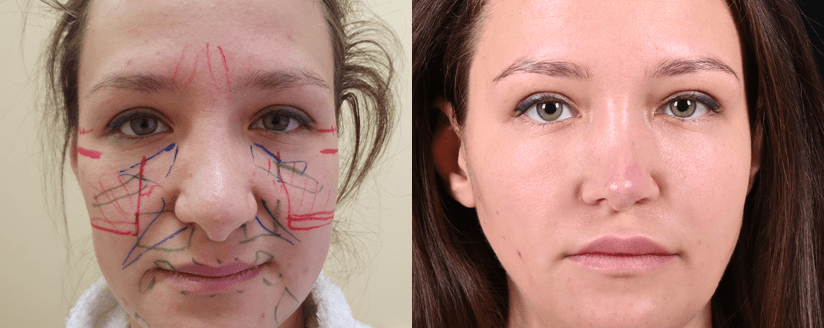 Ринопластика вторичная фото до и после
