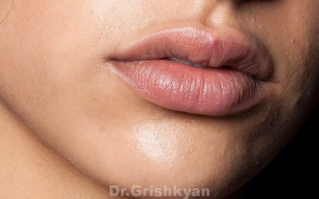 Липофилинг губ в клиники Гришкяна в москве 